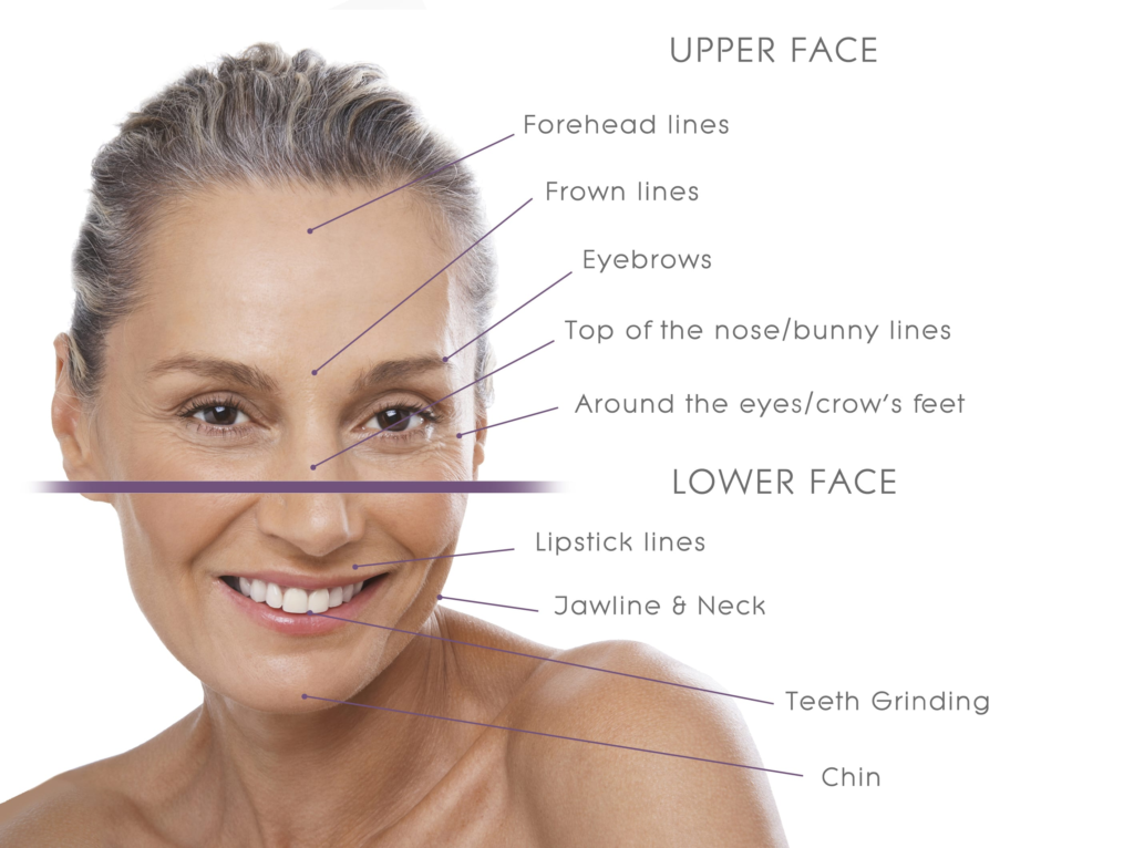 Botox area on face